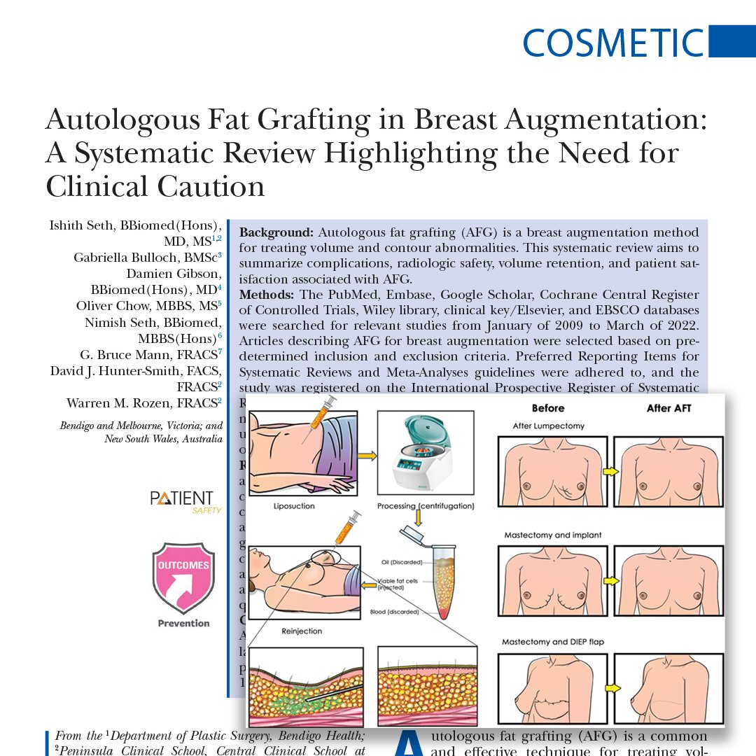 Autologous #fatgrafting (AFG) is a #breastaugmentation method for treating volume and contour abnormalities. This systematic review aims to summarize complications, radiologic safety, volume retention, and patient satisfaction associated with AFG.
Read it: bit.ly/FatGraftClinic…