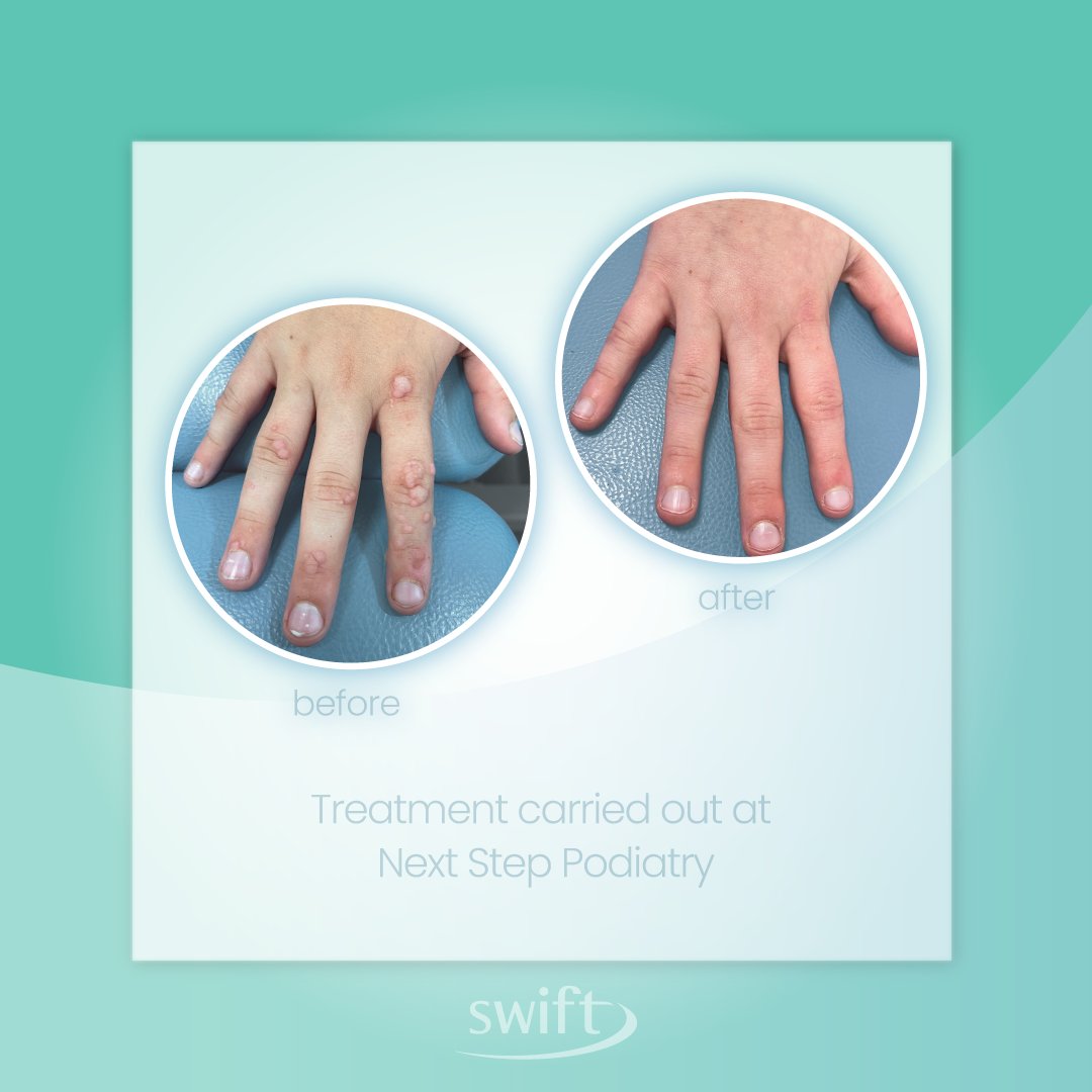 We love seeing the power of Swift!

This young patient had a significant wart infection of 85 warts across both hands. He came to Next Step Podiatry and after treatment with Swift, all the warts were resolved and the patient was over the moon!!