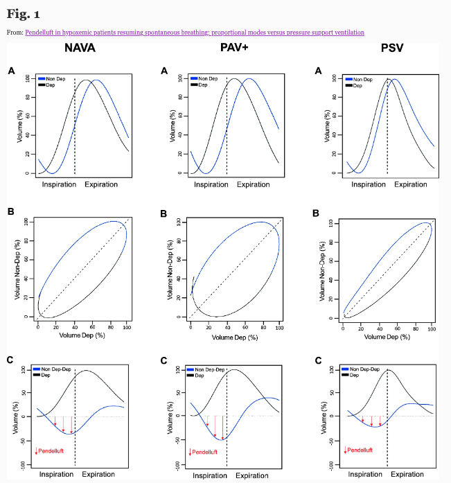 Pendelluft in hypoxemic patients resuming spontaneous breathing: proportional modes versus pressure support ventilation 👤 @Arellano NAVA, PAV + , or PSV for ARDS patients? Article : annalsofintensivecare.springeropen.com/articles/10.11… #ventilatormode #ARDS #AIC #SRLF #FICS