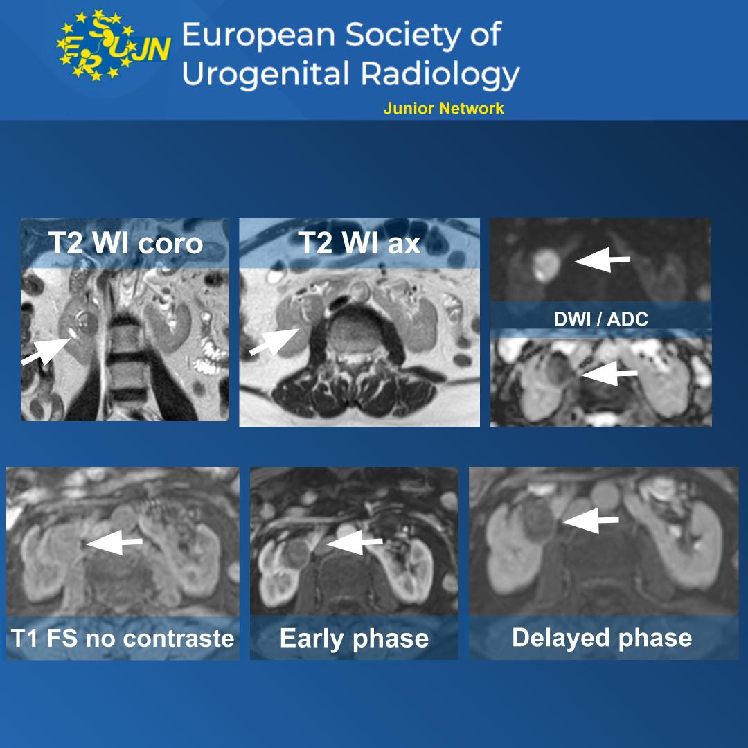 Welcome to this exciting special edition of ⭐TRIVIA THURSDAY⭐ where we will try to characterize a renal image buuuuut... in a HORSESHOE KIDNEY! 🧲🐎 🔵60 yo 🔵Asymptomatic. Look at the images and vote wisely 🦉