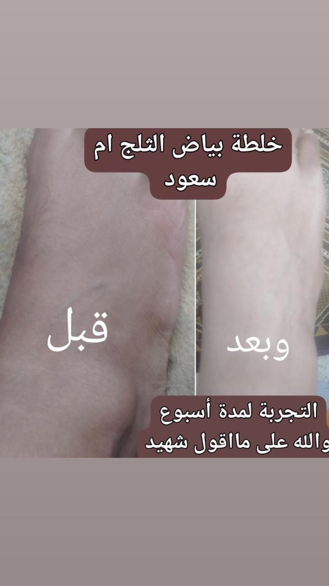 تبييض الوجه والجسم والمناطق الحساسه 🔥🔥
#الكويت_قطر #الجهراء #السالميه #السعودية