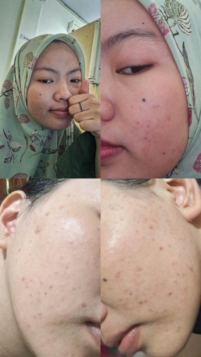milatsss's tweet photo. Siapa yang lagi berjuang lepas dari krim dokter terus jerawatan?
Akuuuuu!!☝️

             Before                               After https://t.co/dXGKNnKbRH