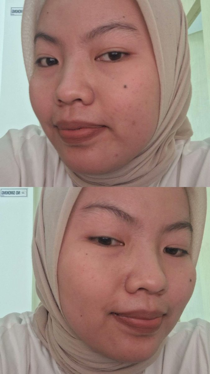 milatsss's tweet photo. Siapa yang lagi berjuang lepas dari krim dokter terus jerawatan?
Akuuuuu!!☝️

             Before                               After https://t.co/dXGKNnKbRH