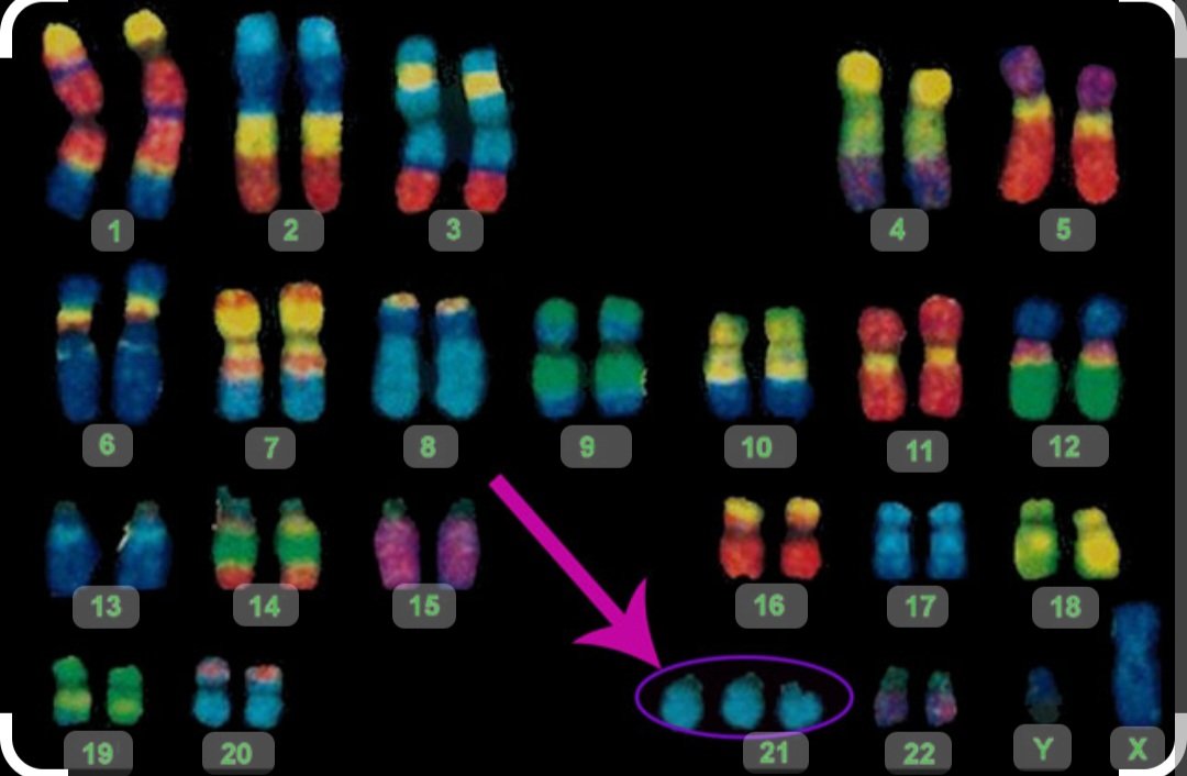 Happy World #DownSyndrome day everyone!!

Please wear your brightest craziest or odd socks or both! To show support for our community.  Socks are chosen as they look a little like chromosomes! People with DS have 3 chromosome 21 hence we celebrate on this date (3rd month, day 21)