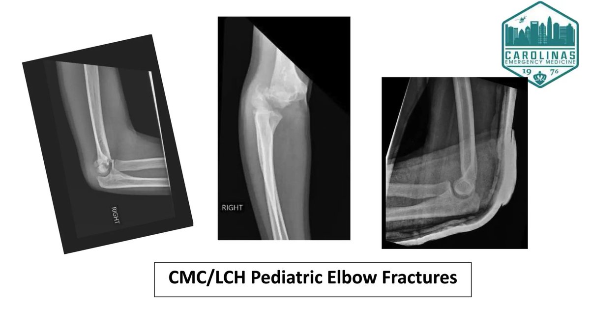 Explore elbow injuries in our latest Pediatric Orthopedic X-Ray Cases series, presented by leading pediatric experts. litfl.com/pediatric-orth… #MedTwitter #MedEd #FOAMed #Radiology