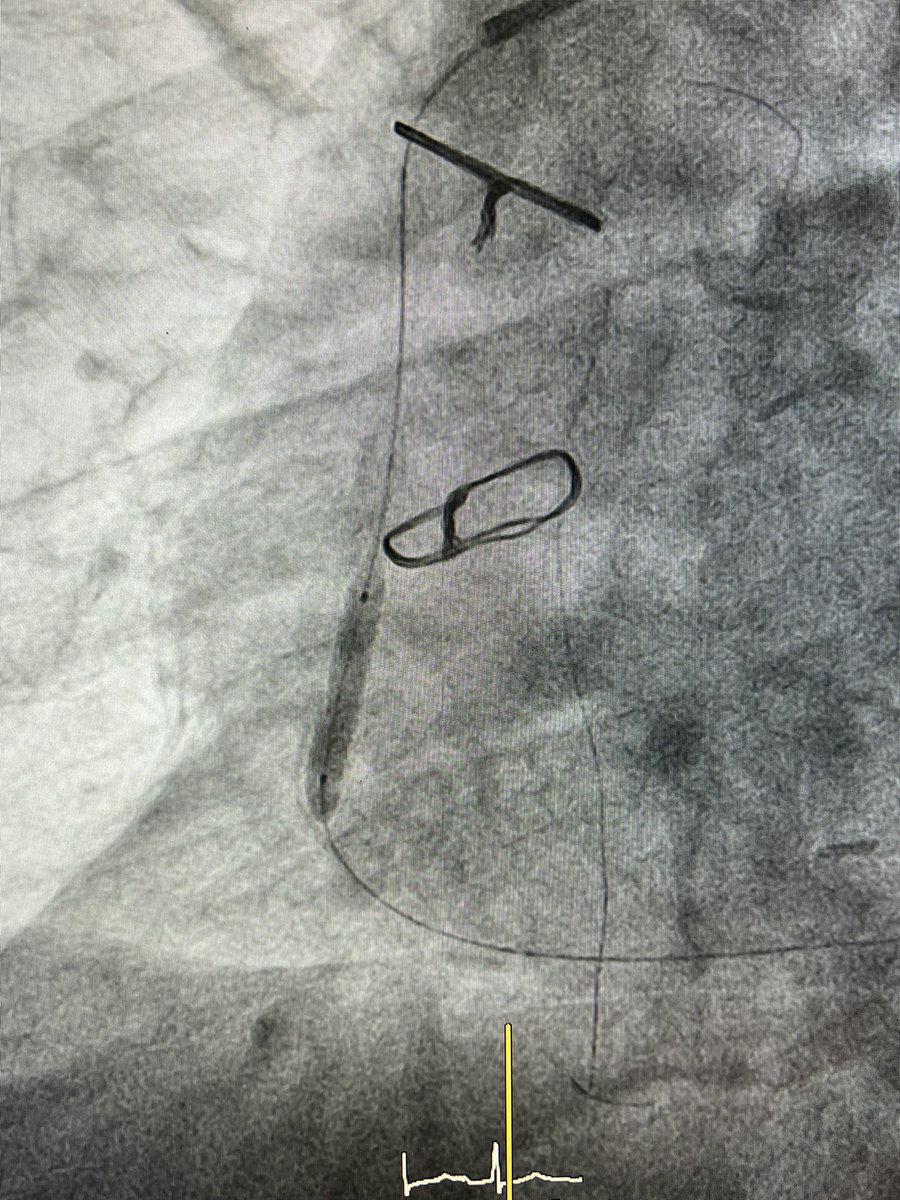Leonidas Koliastasis (@lkoliastasis) on Twitter photo Severely calcified SVG—>PDA with resistant lesion crossed with Fielder XT (finally). Balloons not expanding completely (up to 4.0mm). What would be your next move? <a href="/KToutouzas/">Konstantinos Toutouzas</a> <a href="/elinakaranik/">Elina Karanikola</a>
#CardioTwitter #PCRonline #Calcium #SVG Severely calcified SVG—>PDA with resistant lesion crossed with Fielder XT (finally). Balloons not expanding completely (up to 4.0mm). What would be your next move? <a href="/KToutouzas/">Konstantinos Toutouzas</a> <a href="/elinakaranik/">Elina Karanikola</a>
#CardioTwitter #PCRonline #Calcium #SVG