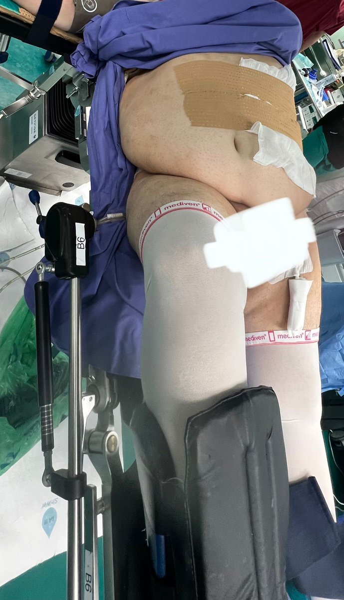 Sometimes it does happen also in Italy especially after #covid… morbidly obese patient 150kg BMI42 with bilateral staghorn stones+ #urosepsis + acute #renalfailure (creatinine 22!) First solve renal insufficiency and sepsis by placing 2 #nephrostomies per side 2) #bilateral