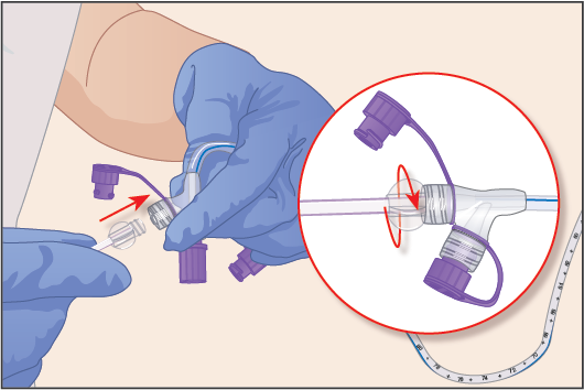 Two updated guides on Nutrition in Adults from the team @clinical_skills. 🔹Inserting a fine-bore nasogastric feeding tube 🔹Nasogastric tubes: Feeding via an enteral pump in a hospital or care setting Go to clinicalskills.net, log in with #OpenAthens. @BH__Academy