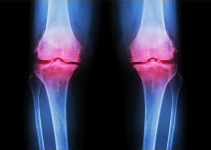 Did you know? Posttraumatic osteoarthritis affects about 12% of symptomatic osteoarthritis patients in the US. Learn how research in biologic and cell therapies could lead to better treatments: medilink.us/amcd # Osteoarthritis #ArthritisResearch #BiologicTherapies
