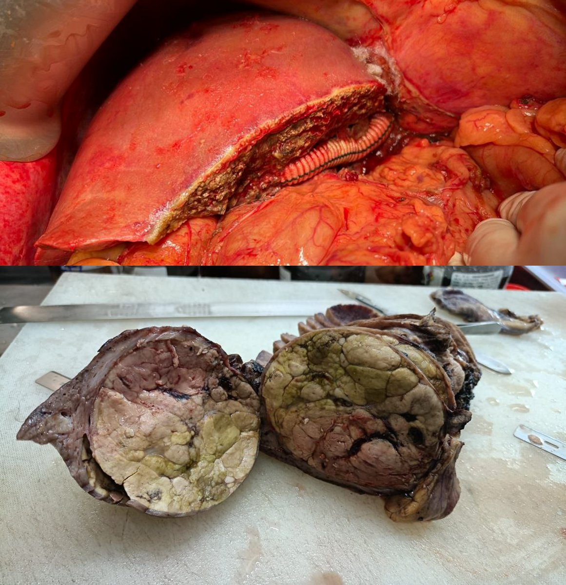 theliverdoc's tweet photo. Will you believe me if I told you the reason why a nice pink healthy liver turned into the grotesque form seen below?

Diabetes.
Absolutely no alcohol.

Diabetes and overweight/obesity are among the most common causes of cirrhosis in India. In fact, metabolic syndrome, of which diabetes and obesity are a part of will soon topple alcohol as commonest cause of fatty liver and cirrhosis in the future.

Sugar is the new alcohol.
Diabetes does to your liver what alcohol does too.

In fact, the largest series of liver cancer in India, done from Kerala found that most common cause of cirrhosis and hence cancer of liver was non-alcohol-related fatty liver disease (now called MASLD).
https://t.co/atagwJ5TjQ

If you have diabetes and is obese/overweight, you can prevent this from happening to your liver by controlling both.

If a person tells you diabetes can be controlled with medications alone, he is wrong. If a person tells you that diabetes can be controlled by diet and exercise alone, he is wrong.

Management of diabetes in the majority may require both. Medications become mainstay in some patients, while lifestyle changes in others. 

Medications for diabetes are life saving. They prevent organ damage due to diabetes. They do not cause organ damage. If the doctor suggests insulin, take it. It is for your own good. Introduction of insulin saved millions of children dying from diabetes. 

None of the alternative medicine practices help you control diabetes. It is all a scam. All supplements that you see on the shelf and online and on social media that claim to control diabetes are desgined and sold by scamsters, some with a PhD and some who are doctors, while some playing the part well. Save your money. There is "no safe and effective diabetes controlling herbal or non-herbal supplement."

You do not need a fancy fad diet to control diabetes and lose weight. Control your portions, and go on a calorie deficit by working out. Limit/ replace high glycemic foods with lower glycemic options. Walking is not an exercise. Brisk walking is. Jogging is. Running is.

If you can shed kilos the safe way, open your mind towards great medical options to control your diabetes and be consistent in your physical activity, rest assured, the chances of your liver looking like the one below, is very slim. 

Exercise and diet control are not the only options for you to lose weight if you have morbid obesity - there are endoscopic techniques and bariatric surgery. These are excellent options. Do not fear these methods because they maybe life saving options. In fact, bariatric surgery reversed cirrhosis and reduced heart related deaths in a fantastic study. Speak to your doctor to see if you are a candidate for the same.
Check out the terrific SPLENDOR Study here:
https://t.co/76mstCIr2G

Please read this fantastic layman guideline on non-alcoholic fatty liver disease for the patient, from Journal of Hepatology Reports by the European Association of Study of the Liver: https://t.co/eQHiqkOHxW