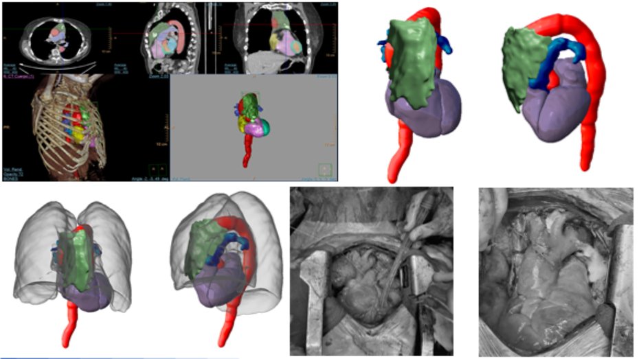 FabLab 3D Hospital Marañón (@3d_maranon) on Twitter photo Anatomical virtual model (CMD I) for surgical planning in case of thymoma (TET) Interdisciplinary work between <a href="/3d_maranon/">FabLab 3D Hospital Marañón</a> & <a href="/CardiacMaranon/">Cardiac Surgery Gregorio Marañon Hospital</a> to ensure tumor limits and precise surgery
<a href="/rupermac/">Rubén Pérez-Mañanes, MD PhD</a> <a href="/calvoharo_ja/">José Antonio Calvo</a> Anatomical virtual model (CMD I) for surgical planning in case of thymoma (TET) Interdisciplinary work between <a href="/3d_maranon/">FabLab 3D Hospital Marañón</a> & <a href="/CardiacMaranon/">Cardiac Surgery Gregorio Marañon Hospital</a> to ensure tumor limits and precise surgery
<a href="/rupermac/">Rubén Pérez-Mañanes, MD PhD</a> <a href="/calvoharo_ja/">José Antonio Calvo</a>