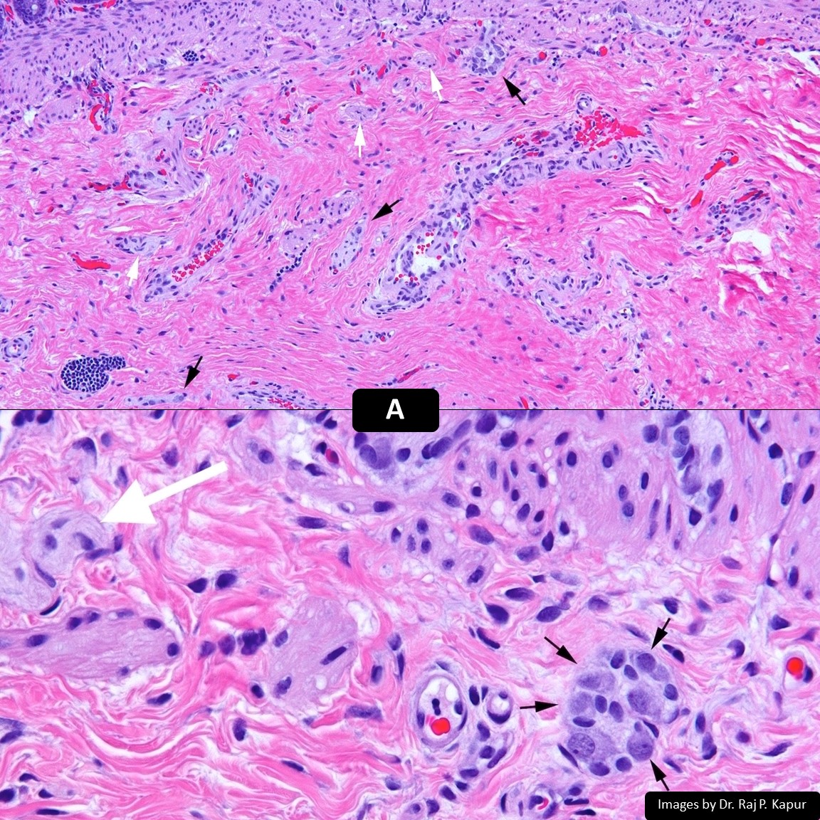 DrCycloPath's tweet photo. #1 of 3
A or B = Hirschsprung?
#GIPath #PathTwitter #PediPath
🖼️🙏Dr. Raj P. Kapur
https://t.co/ktWIb2Rpjo https://t.co/hOzgrCga6K