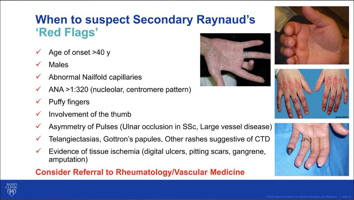 LastManStand85's tweet photo. Secondary #Raynauds 

Red Flags &amp; When to Suspect 🚩:- 

#Rheumatology #MedTwitter #MedEd https://t.co/7zQbGGBdwN