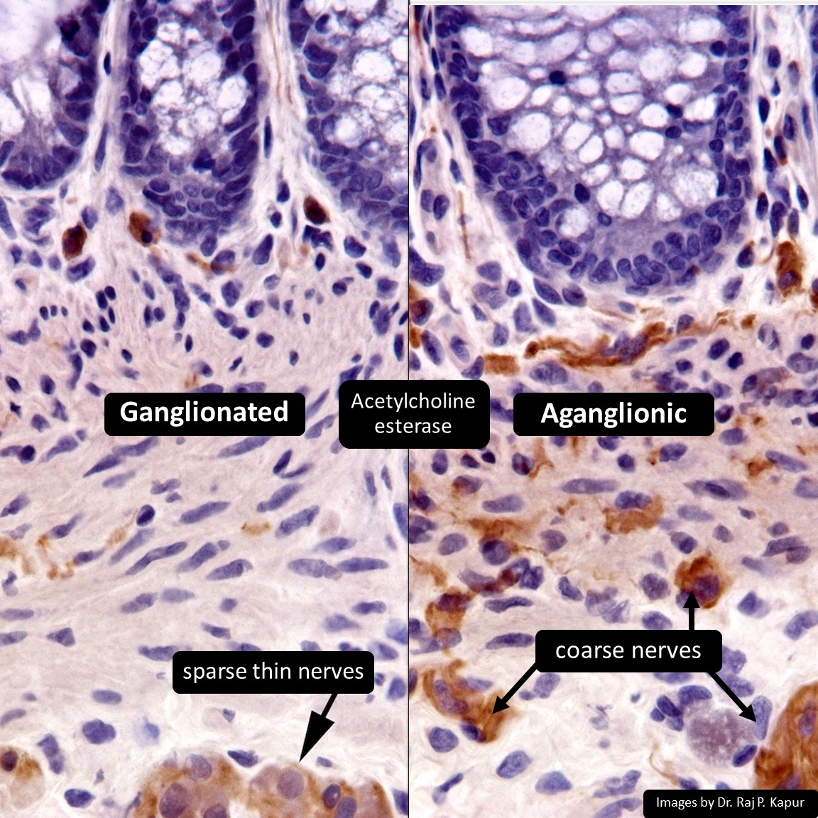 Normal bowel has +calretinin intrinsic nerve fibers without cholinergic extrinsic nerve 'hypertrophy' Hirschsprung bowel shows loss of calretinin and ropey staining for AChE/ChT 🖼️🙏Dr. Raj P. Kapur pathologyoutlines.com/topic/colonhir… #GIPath #PathTwitter #PediPath ✅B for #1, #2, & #3