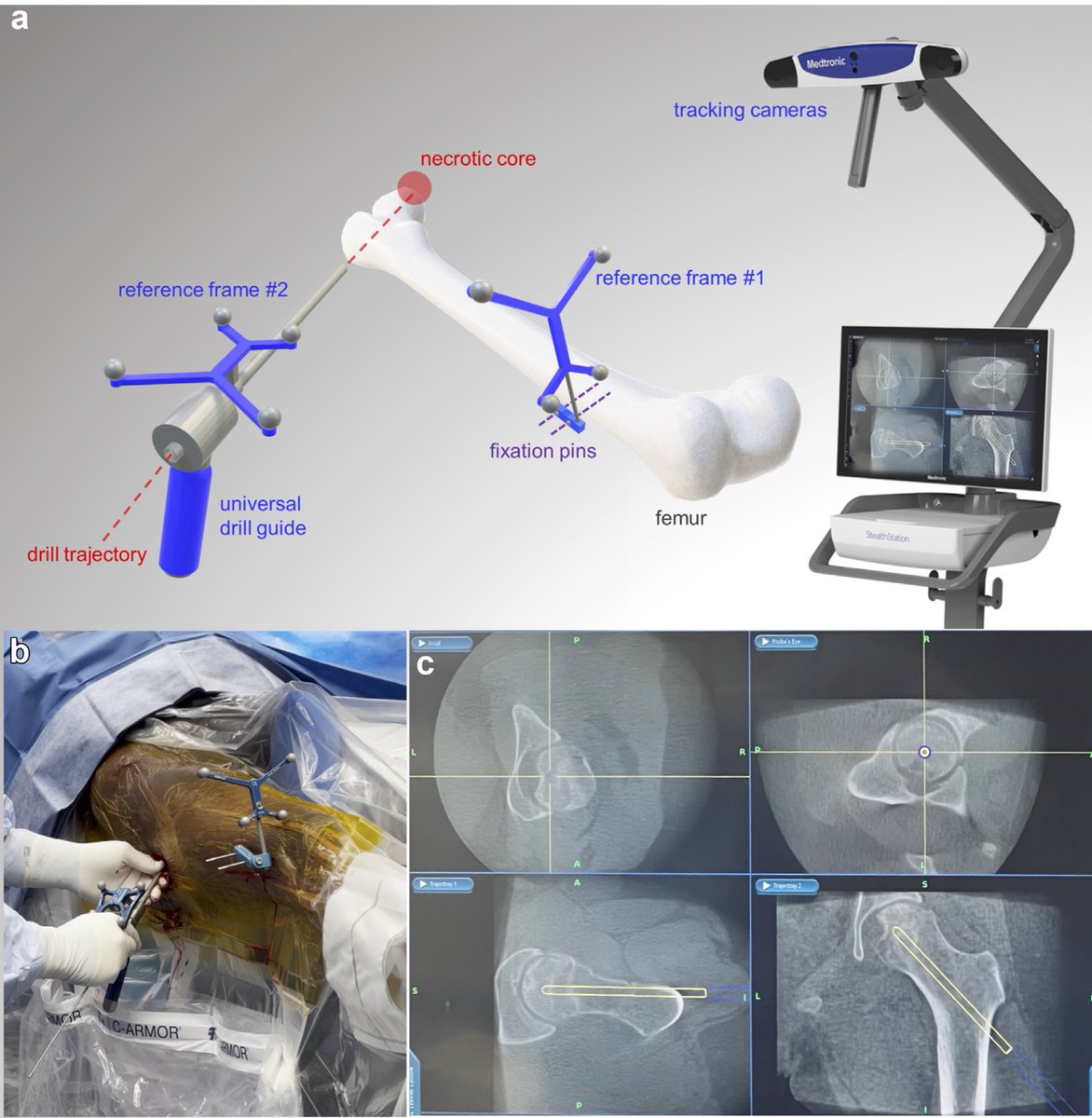 Arthroplasty Today (@arthrotoday) on Twitter photo This surgical technique paper from <a href="/OrthoAtYale/">Yale Department of Orthopaedics and Rehabilitation</a> describes using CT-based 3-D modeling and instrument tracking to assist with core decompression for osteonecrosis of the femoral head. <a href="/DrDanielWiznia/">Daniel Wiznia, MD</a> <a href="/AlborzFeizi/">Alborz Feizi MD, PhD</a> <a href="/DrLeeRubin/">Lee E. Rubin, M.D., FAAOS, FAAHKS, FAOA</a> <a href="/ChrisGraysonMD1/">ChrisGraysonMD</a> <a href="/DrViruega/">Dr Juan Viruega</a>
arthroplastytoday.org/article/S2352-⦠This surgical technique paper from <a href="/OrthoAtYale/">Yale Department of Orthopaedics and Rehabilitation</a> describes using CT-based 3-D modeling and instrument tracking to assist with core decompression for osteonecrosis of the femoral head. <a href="/DrDanielWiznia/">Daniel Wiznia, MD</a> <a href="/AlborzFeizi/">Alborz Feizi MD, PhD</a> <a href="/DrLeeRubin/">Lee E. Rubin, M.D., FAAOS, FAAHKS, FAOA</a> <a href="/ChrisGraysonMD1/">ChrisGraysonMD</a> <a href="/DrViruega/">Dr Juan Viruega</a>
arthroplastytoday.org/article/S2352-ā¦