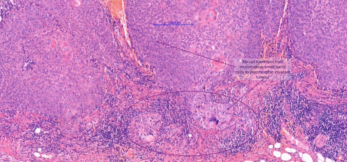 Beware of subtle atypia and parakeratosis in “Seborrhoeic / follicular Keratosis”: 

Well diff Follicular (ostial) SCC 

#dermpath #dermtwitter #pathtwitter #pathresident #dermatologia #dermatology  #dermatologist #dermatopathologia #dermatopathology #dermatopathologist