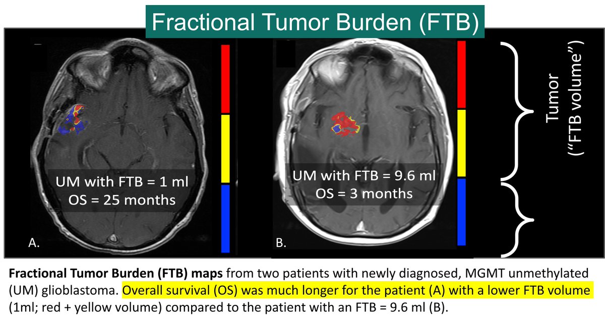 ImgBiometrics's tweet photo. @IQAI_IB's FTB maps show blue, red, and yellow regions to indicate treatment effect, vascular/high-grade tumor, and a transition zone. Beneficial for assessing treatment response, neurosurgical mgmt, improving interreader agreement, etc. 
@CNS_Update  @NeuroOnc @TheASNR @theABTA https://t.co/VtSa0TLttZ