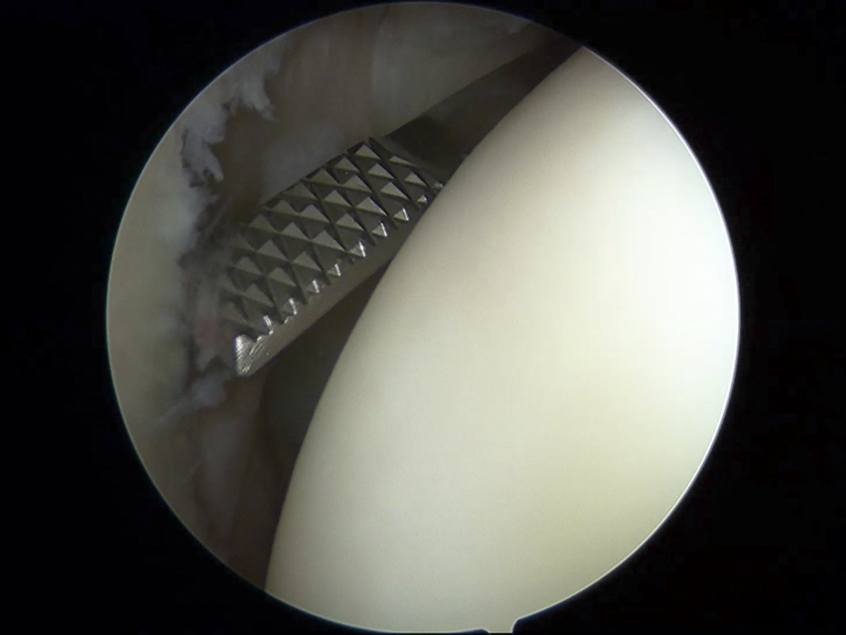 Capsuloligamentous shoulder laxity was a significant independent risk factor for failure after primary arthroscopic Bankart repair without remplissage and was more predictive of failure in patients with versus without near-track lesions. ow.ly/aQIF50QNLnS