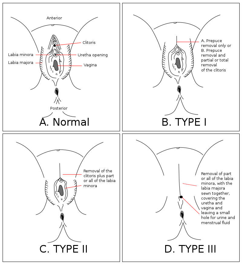 ras_le_foulard's tweet photo. ⚠️ TW MUTILATION EXCISION ⚠️

Je pense que vous captez pas ce que c'est que de subir une excision. Selon l'OMS, voici : 
A. La représentation d'une vulve lambda
B. Le résultat d'une clitoridectomie
C. Le résultat d'une excision
D. Le résultat d'une infibulation https://t.co/UO4BEOWU6c