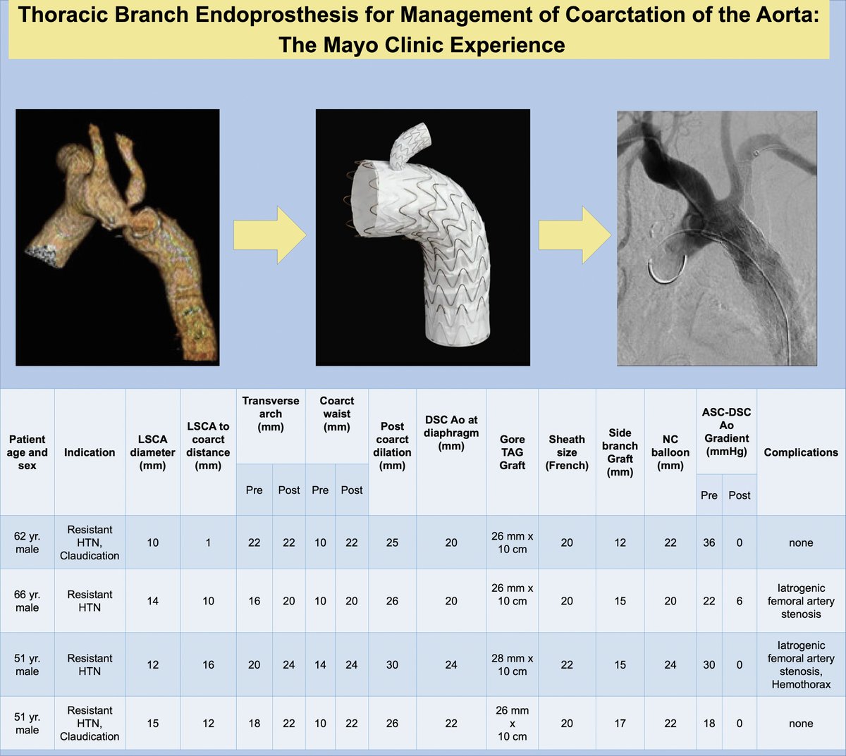 MyJSCAI (@myjscai) on Twitter photo 📚Novel use of branched TAG graft for treatment of Coarctation of Aorta w challenging anatomies #StentGraft
➡️ doi.org/10.1016/j.jsca…
<a href="/PradyAgasthiMD/">Pradyumna Agasthi</a> <a href="/Dr_JHAnderson/">Jason H. Anderson, M.D.</a> <a href="/drbermendes/">Bernardo Mendes</a> <a href="/allisoncabalka/">Allison Cabalka</a> 📚Novel use of branched TAG graft for treatment of Coarctation of Aorta w challenging anatomies #StentGraft
➡️ doi.org/10.1016/j.jsca…
<a href="/PradyAgasthiMD/">Pradyumna Agasthi</a> <a href="/Dr_JHAnderson/">Jason H. Anderson, M.D.</a> <a href="/drbermendes/">Bernardo Mendes</a> <a href="/allisoncabalka/">Allison Cabalka</a>