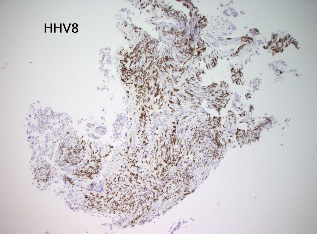 40s M Lung mass. Very unexpected findings... #ThoracicPath #PathX #PathTwitter