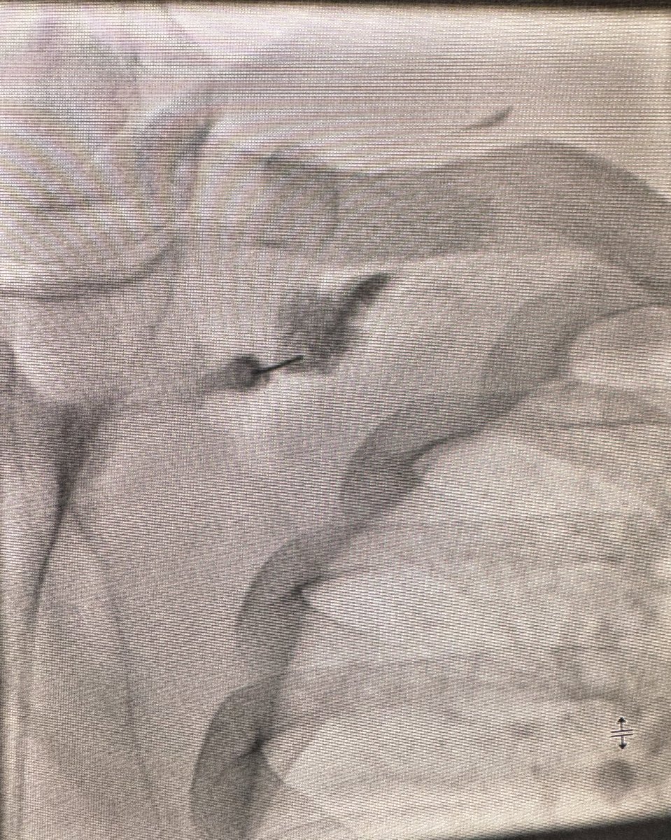 Beautiful flouroscopic suprascapular neurogram during a SSN block I did recently. I find these tricky with US and have had good results with FL. How are other people doing these? US or FL? <a href="/MGHImaging/">Mass General Imaging</a> <a href="/SSRbone/">Society of Skeletal Radiology</a>