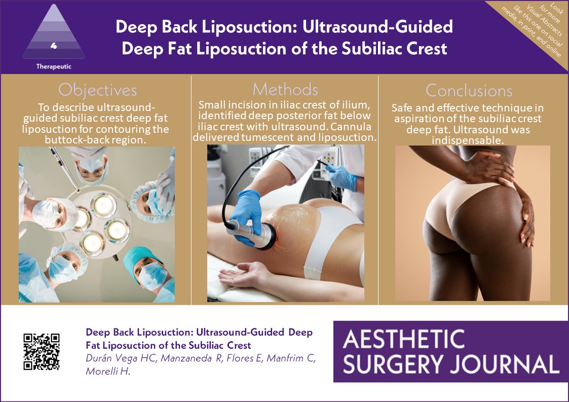 Aesthetic Surgery Journal/ASJ Open Forum (@asjrnl) on Twitter photo Looking for a safe and effective technique in achieving aspiration of the subiliac crest deep fat, to enhance the frame for buttock-back contouring? Read here: bit.ly/4aa1Ci8
<a href="/jgusenoff/">Jeffrey Gusenoff, MD</a>
<a href="/DrJAhmad/">Dr. Jamil Ahmad</a>
<a href="/drkenkel/">Jeffrey Kenkel, MD</a>
<a href="/NahaiDr/">Dr Nahai</a>
<a href="/TheAestheticSoc/">The Aesthetic Society</a>
<a href="/drroykim/">Roy Kim 🇺🇸</a> Looking for a safe and effective technique in achieving aspiration of the subiliac crest deep fat, to enhance the frame for buttock-back contouring? Read here: bit.ly/4aa1Ci8
<a href="/jgusenoff/">Jeffrey Gusenoff, MD</a>
<a href="/DrJAhmad/">Dr. Jamil Ahmad</a>
<a href="/drkenkel/">Jeffrey Kenkel, MD</a>
<a href="/NahaiDr/">Dr Nahai</a>
<a href="/TheAestheticSoc/">The Aesthetic Society</a>
<a href="/drroykim/">Roy Kim 🇺🇸</a>
