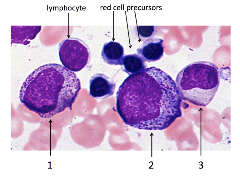 PathJared's tweet photo. https://t.co/Tyb55uaHSd  - Day 4

I struggled with promyelocytes vs myelocytes during my #hemepath rotation. Importantly, promyelocytes have only primary (azurophilic) granules while myelocytes also have secondary (specific) granules. What are the numbered cells below?   #PathX https://t.co/kFxdARuvBL