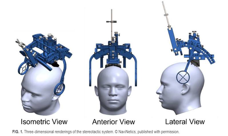 A new FDA cleared stereotactic system for single-stage, asleep DBS surgery achieved a mean radial error of 1.24±0.45 mm in lead placement. <a href="/TheJNS/">Journal of Neurosurgery</a>

<a href="/AANSNeuro/">AANS</a> <a href="/CNS_Update/">CNS</a>
#ASSFN #neurosurgery #MedTwitter