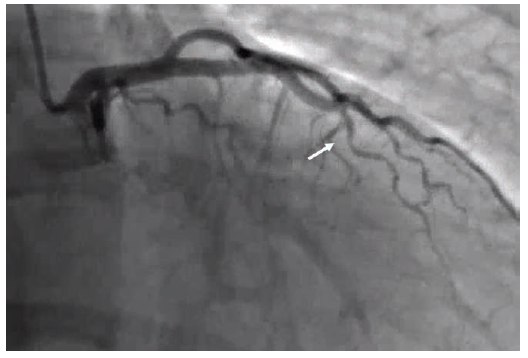 Think SCAD (Spontaneous Coronary Artery Dissection) for MINOCA (Myocardial Infarction in Patients With Unobstructed Coronary Arteries) @mortkern w/ expert colleagues Drs. Steve Ramee; Jacqueline Saw @docsaw; Jon Tobis; and Barry Uretsky. #cardiotwitter okt.to/4xAtFb