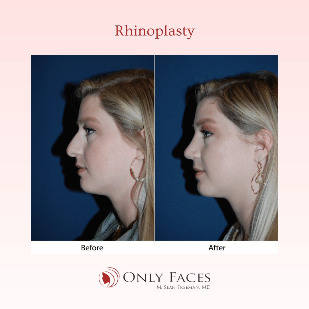 OnlyFacesCLT's tweet photo. This 20-year-old is two months post-op from a #Rhinoplasty. #OnlyFaces https://t.co/FiHN2Aw7Un