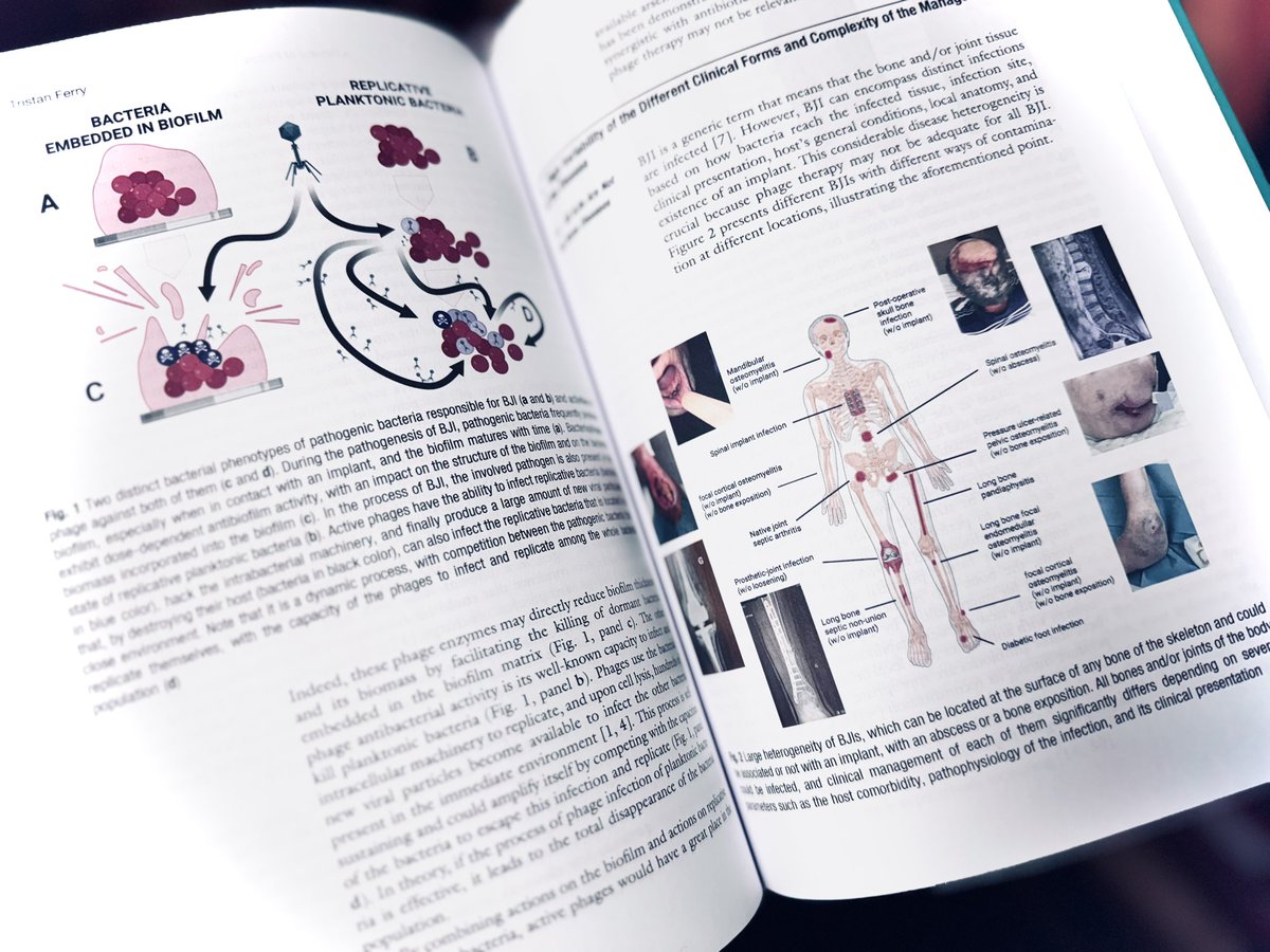 FerryLyon's tweet image. ✨ Very pleased to have contributed to this new #phagetherapy bible 📗➡️ link.springer.com/book/10.1007/9…! This long-awaited second edition of the acclaimed &quot;Bacteriophage Therapy; From Lab to Clinical Practice&quot; edited by Sanna Sillankorva and Joana Azeredo @azeredo_joana details…