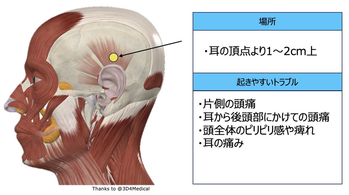 原因不明の耳〜後頭部にかけての頭痛や、頭全体の痺れある場合は、ここの筋膜が硬くなっていることがあります。

耳の頂点から1-2cm上の筋肉に指の腹を当て、軽く圧をかけながら色んな方向に動かします。

硬くて鋭めの痛みがある時は筋膜が硬くなっている可能性大なので、やわらぐまでケア☺︎
