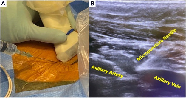 The Ultrasound version of the Caudal Tilt for device implant access thanks to my @nyulangone colleagues. Because who needs pneumothoraxes? Article free till May 10: authors.elsevier.com/c/1ioJa5VtUyWQ…
