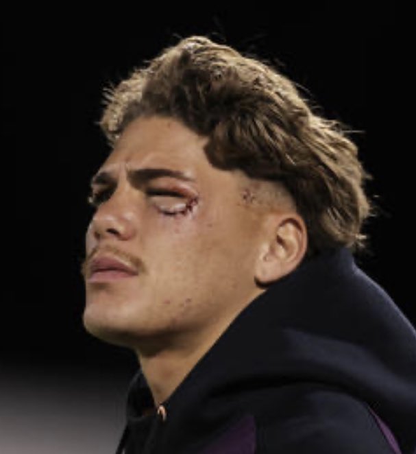 FACIAL FRACTURE FOR WALSH @brisbanebroncos Dave Ballard confirms: “A CT scan showed a facial fracture for Reece.” Walsh, who will return to Brisbane by car, to see specialist to determine how much time he will miss. Big blow.