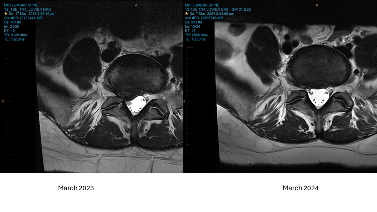 Saw case of disc resorption in a few months. Here are MRIs March 2023, Sept 2023 &amp; March 2024. Symetrical LBP started as leg pain stopped. Now no rad symptoms at all. The resorption happened since Sept 2023. Amazing.