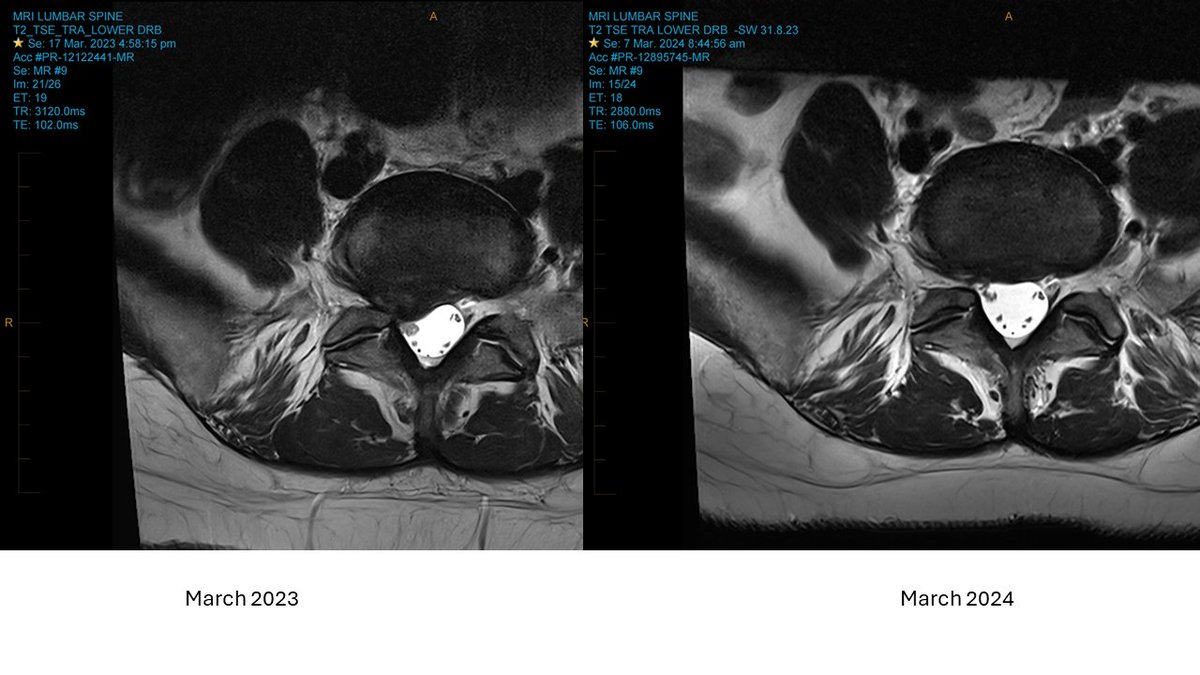 Saw case of disc resorption in a few months. Here are MRIs March 2023, Sept 2023 & March 2024. Symetrical LBP started as leg pain stopped. Now no rad symptoms at all. The resorption happened since Sept 2023. Amazing.