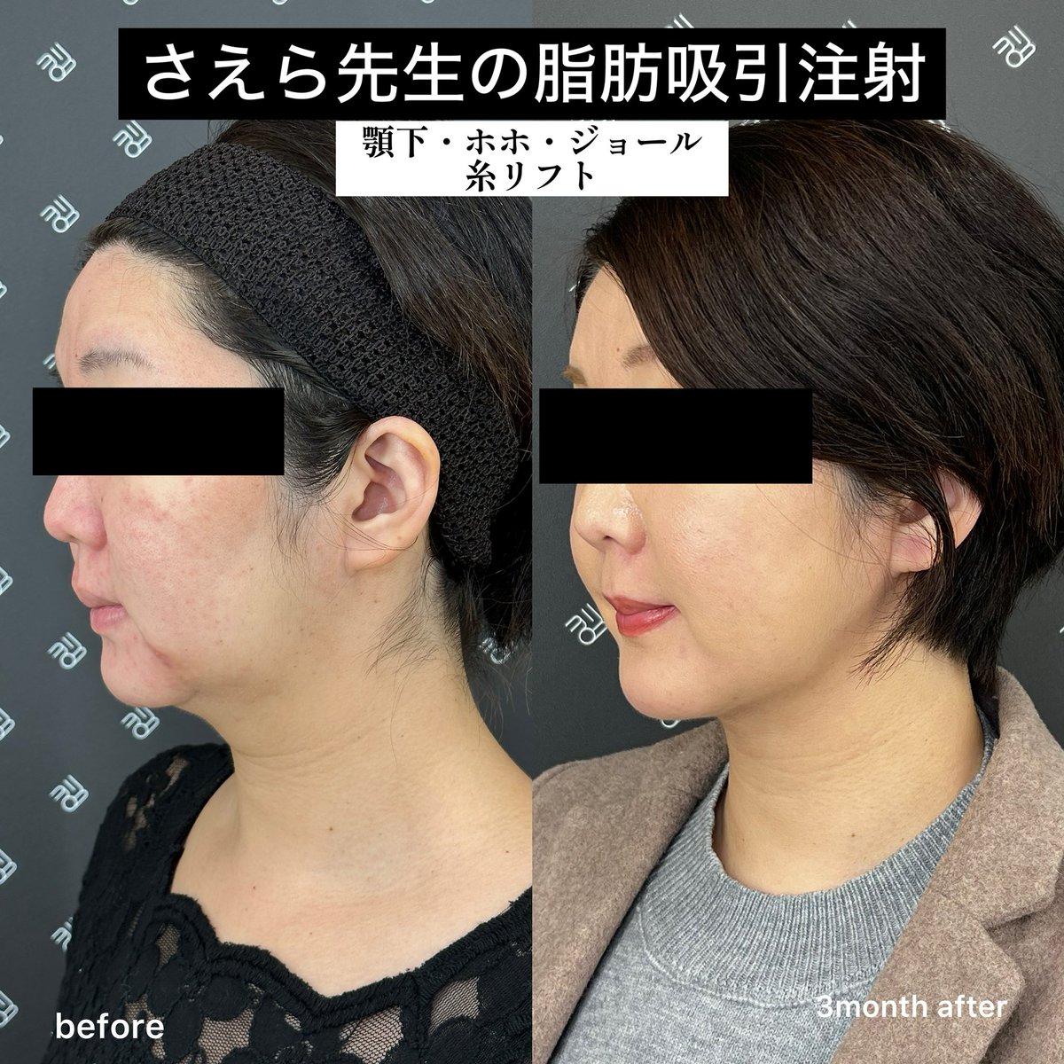 Drsaera's tweet photo. なぜ脂肪吸引注射推しなのか？

脂肪吸引注射はダメという人もいますが僕はおすすめしています。
なぜなら僕が前職で、
「脂肪吸引の仕上げに脂肪吸引注射を使っていた」
からです。
脂肪吸引注射は管が細いため、細かい調整やアゴの骨をクッキリ出すことが得意です。なので仕上げに利用していました。

「仕上げに使うんだったら最初から脂肪吸引注射の方が傷跡小さくて良くね？」
と思って脂肪吸引注射で脂肪吸引並みにゴリゴリ脂肪を取りまくる方向性で始めてみたら、脂肪吸引と全然変わらない仕上がりになりました。
手術時間はすこし長くなりますが、仕上がりも綺麗だから脂肪吸引注射で十分だし、抜糸がいらなかったり傷跡のリスクが小さかったり、むしろお客様にメリットがあるということで脂肪吸引注射をお勧めしています。

ただ、僕のおこなっている脂肪吸引注射は脂肪吸引並みの仕上がりを目指しているため、ダウンタイムが短くないです。フェイスバンドも必要です。
ダウンタイムはほぼ脂肪吸引と同じか、若干軽いくらいです。
脂肪吸引注射のメニューを置いているクリニックには2パターンあります。
・ダウンタイムの短い脂肪吸引注射
・脂肪吸引並みの効果を出す吸引注射
前者の場合はダウンタイムが少ないメリットはありますが、ダウンタイム短縮のために脂肪が取れる量を意図的に少なめにしているので、個人的にはあまりお勧めしません。脂肪吸引は2回目は難易度が上がりますしね。