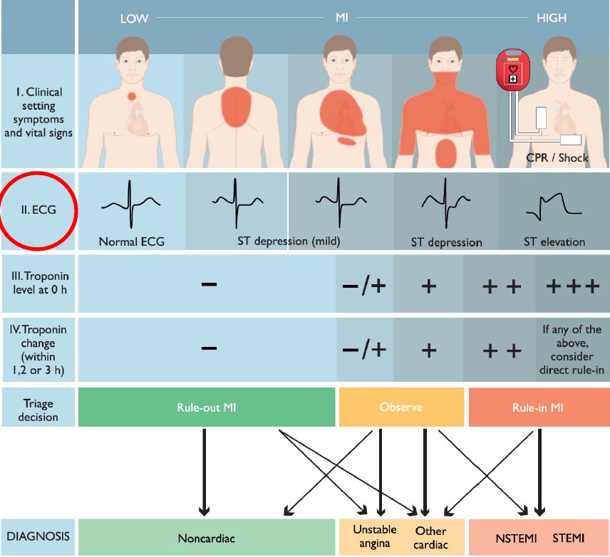 walinjom's tweet image. A Normal ECG does  NOT   exclude Acute coronary syndrome. 

About 30% of patients with NSTEMI have a Normal ECG.

#CardioTwitter 
#MedTwitter