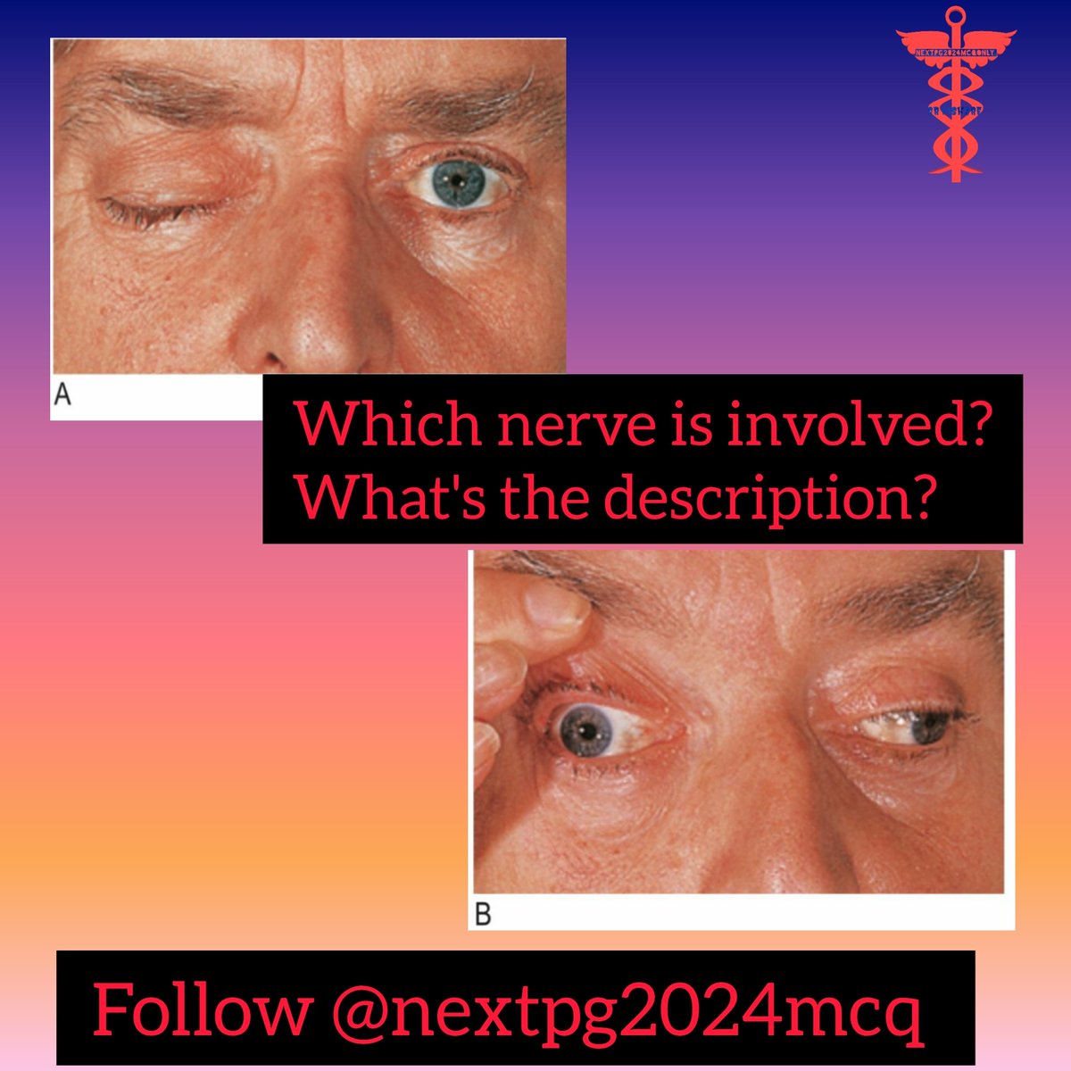 24ptka's tweet image. CLINICAL MCQ:
#NEETPG2024 
#fmge2024 
#nextpg 
#inicet2024 
#medico
#neetpg
#medicine
