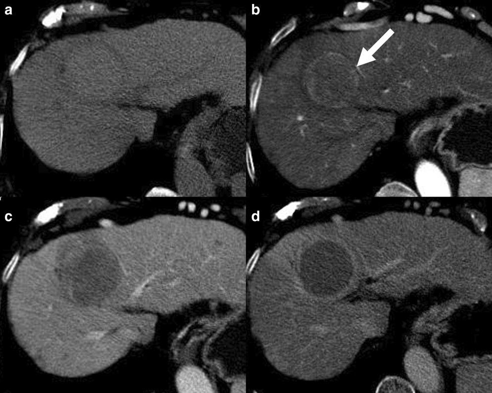 ESR Essentials: diagnosis of hepatocellular carcinoma—practice recommendations by @EsgarSociety. (@cannella_rob et al.) #EuropeanRadiology 🔗 buff.ly/3TgzP90
