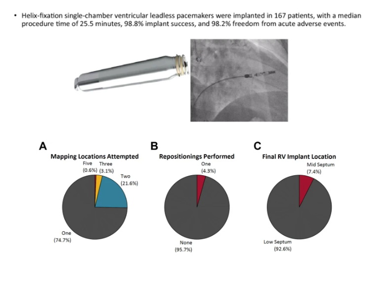 🚨Latest #FreeRead Article in @JICE_EP Early Real-World Implant Experience with a Helix-Fixation Ventricular Leadless Pacemaker 🧐📖rdcu.be/dB8fx by @Drdevignair, @DVExner, @VivekReddyMD, Nima Badie, David Ligon, Marc A. Miller, @DrBridgetLee, @bkdoty, Athanasios…