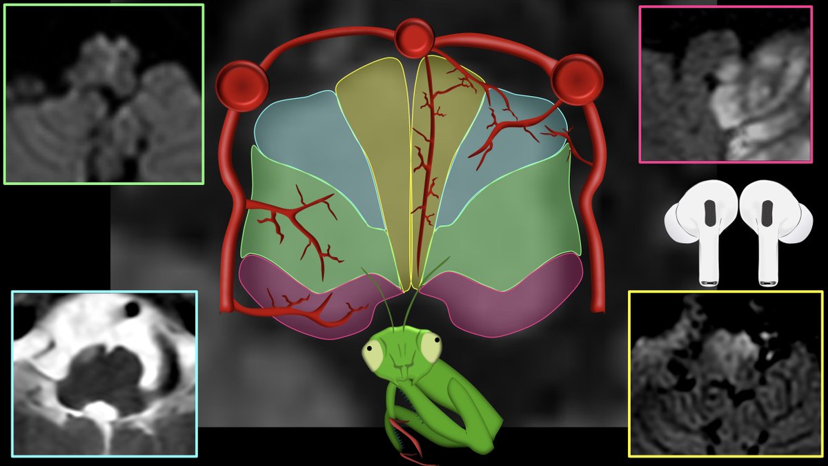 1/The medulla is anything but DULL!

Does seeing an infarct in the medulla cause your heart to skip a beat?

Does medullary anatomy send you into respiratory arrest?

Never fear, here is a thread on the major medullary syndromes!