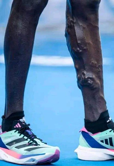 the_beardedsina's tweet image. QUESTION OF THE DAY

The Legs of 2 of the Fastest runners on Earth.

What is this ?
What causes this?
Is this safe or dangerous ?

Share, Drop a comment...