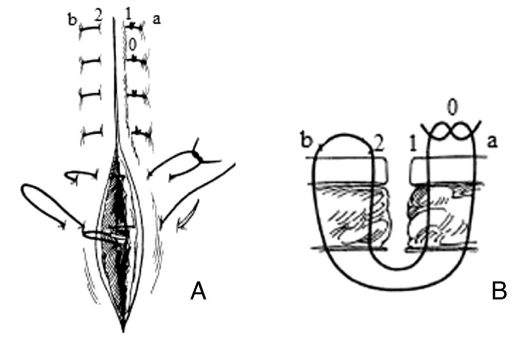 PipeCabreraV's tweet photo. Vertical mattress suture: how to do it ⤵️💥💡⚡️🩸! #SoMe4Surgery @pferrada1 @BBASS_skills @David_ukan @Cirbosque @AmJSurgery https://t.co/hdIVI3vLBX