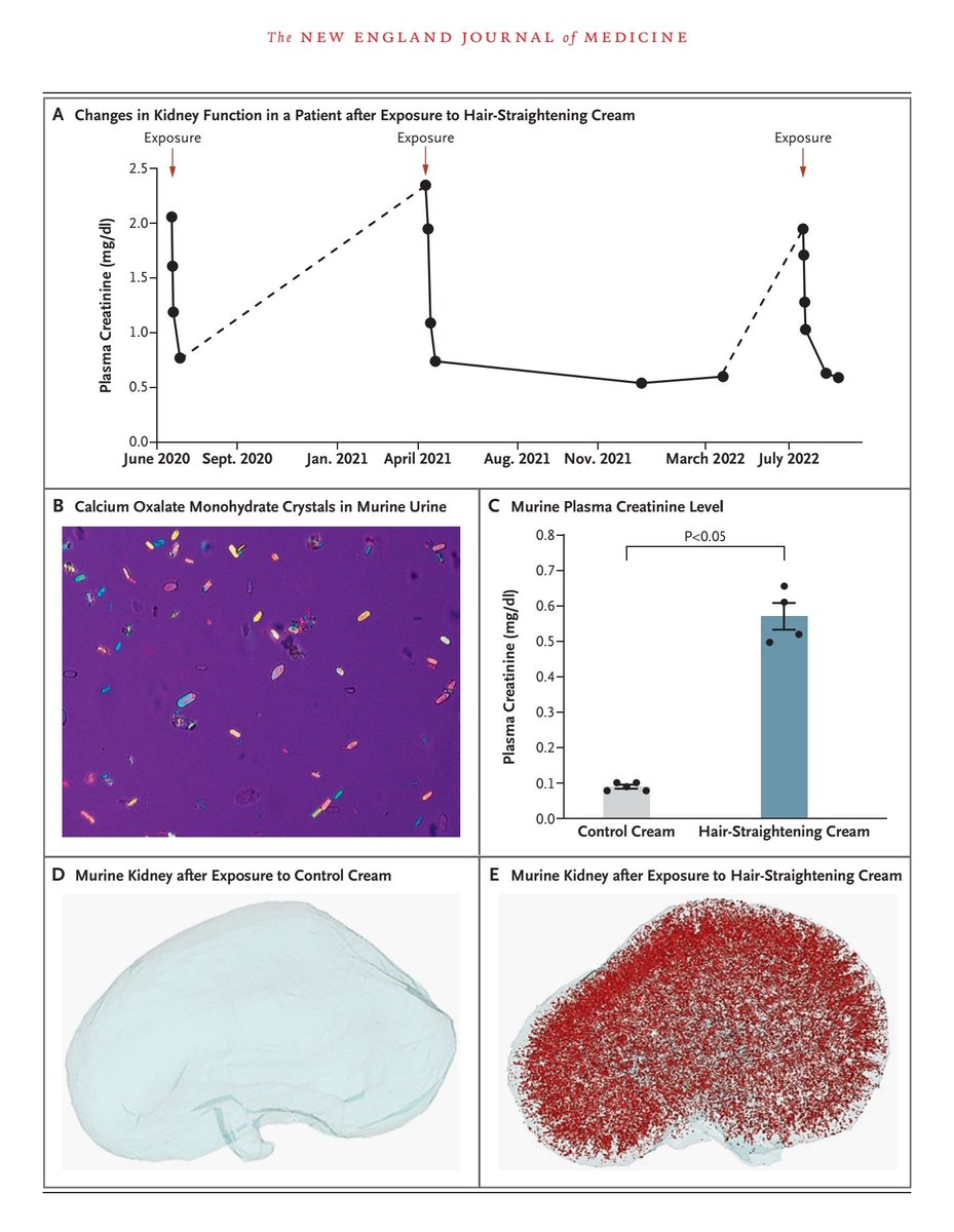 Hair-straigntening products and the risk of AKI 😮 Glycolic acid ➡️ transcutaneous absorption ➡️Oxalate nephropathy nejm.org/action/showFul… #MedTwitter