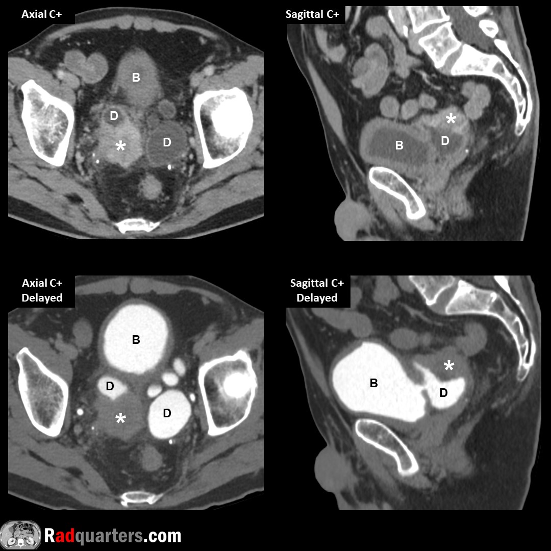 Urothelial carcinoma (*) arising in a bladder (B) diverticulum (D). Bladder most common site for urothelial carcinoma (AKA transitional cell carcinoma), but only rarely seen in diverticula. Bladder diverticula can also be complicated with infection or calculi. #FOAMrad #radres
