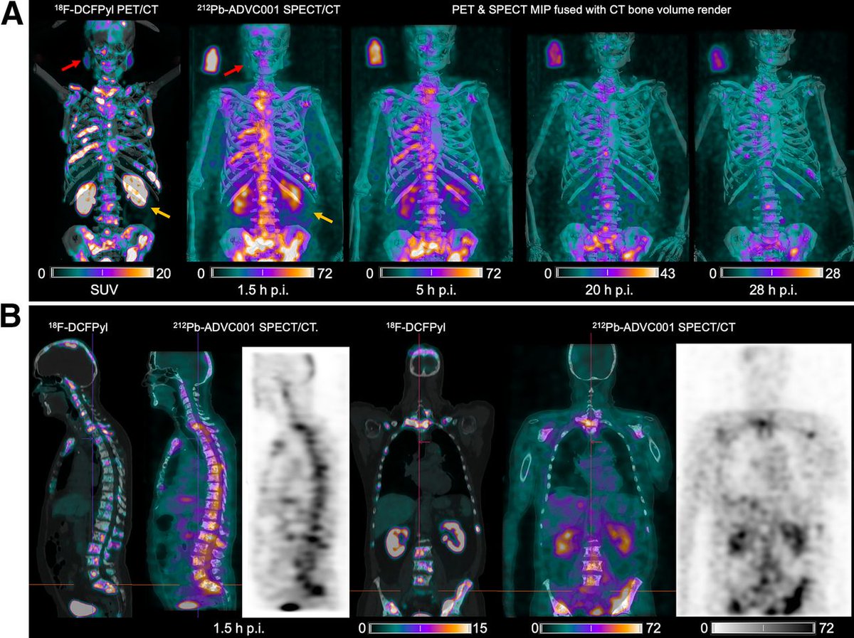 JNM Illustrated Post: First-in-human ²¹²Pb-PSMA–targeted α-therapy SPECT/CT imaging in a patient with metastatic castration-resistant prostate cancer. ow.ly/1kt750QMSCL #NuclearMedicine #RPTherapy #ProstateCancer @DrDavePattison @AdvanCell_Iso