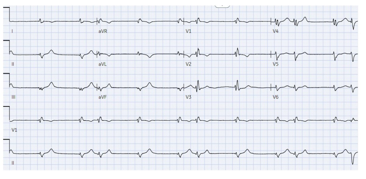 #EPpeeps whats going on here? @drrakeshg1 @nbwiggins @drbilalmunir @JPayne_EP @narrowQRS