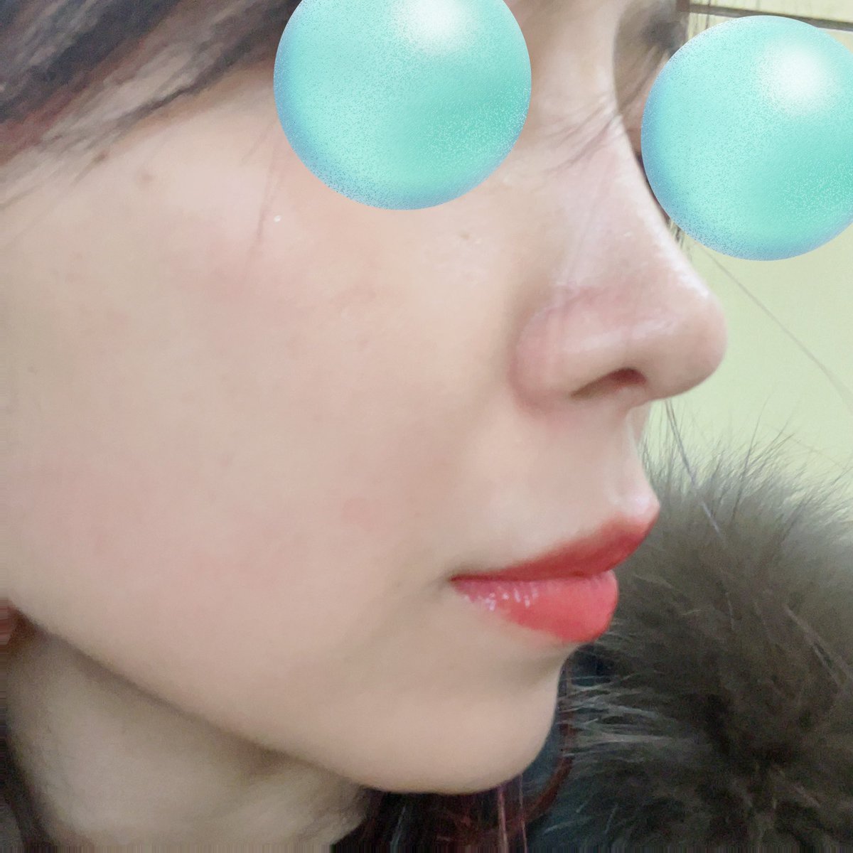 temporary5862's tweet photo. 来月で鼻してから10ヶ月目！特に問題なく。ビタミンCとビオチンのサプリが習慣化して鼻のため以外にも体によさそう🫶あっという間に10ヶ月経ったけど手術後は鼻も全然痛くなくて鼻血もほとんど出てなかった。けど私の場合は頭痛と吐き気がひどくてずっとホテルで寝てたのを思い出す🤭今日このごろ🫡 https://t.co/3nbhzPzuSK